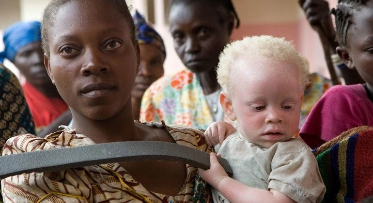 Qara günəş altında ağdərililər, Albinos