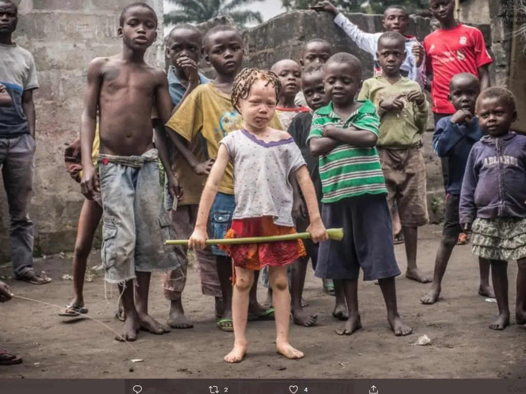 Qara günəş altında ağdərililər, Albinos