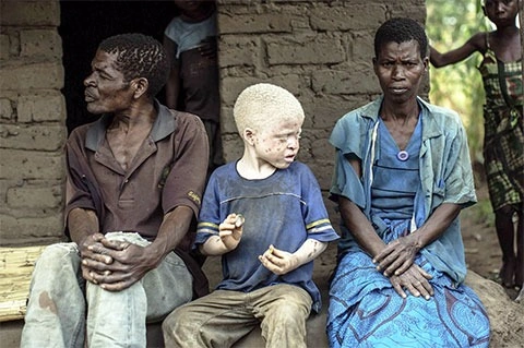 Qara günəş altında ağdərililər, Albinos