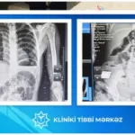 17 yaşlı yeniyetmənin bağırsağından taxta çıxarılıb