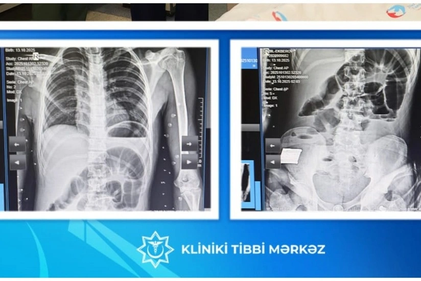 17 yaşlı yeniyetmənin bağırsağından taxta çıxarılıb