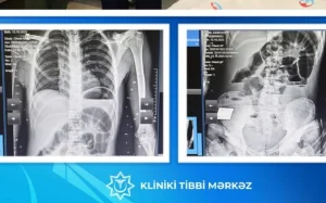 17 yaşlı yeniyetmənin bağırsağından taxta çıxarılıb