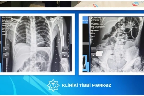 17 yaşlı yeniyetmənin bağırsağından taxta çıxarılıb